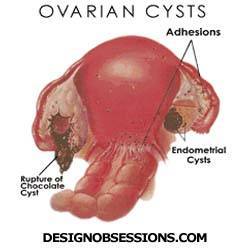Obat Kista Ovarium